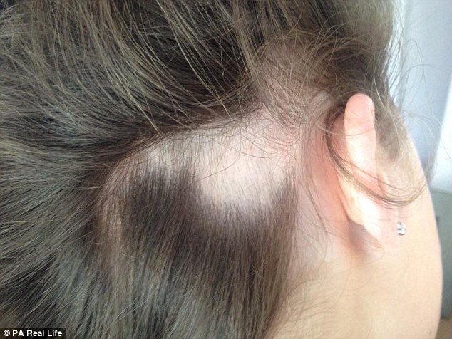 The teenager described how she first noticed a small bald patch when she was fiddling with her hair during a class at school 