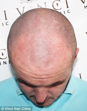 It is claimed hair tattoos are pain free, with most clients describing a light tingling sensation in the scalp. Bryan Slaven is pictured before ndergoing the Micro Scalp Pigmentation treatment