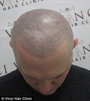 Since having the Micro Scalp Pigmentation treatment, he can finally leave the house without one