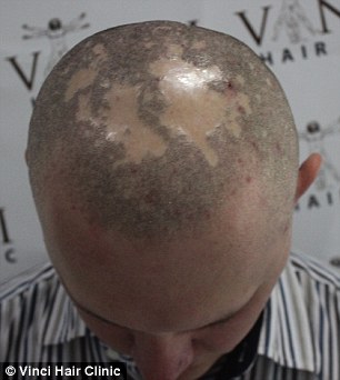 Kamil Szczepanik suffered from alopecia and had to wear a hat for a long time to cover his balding areas